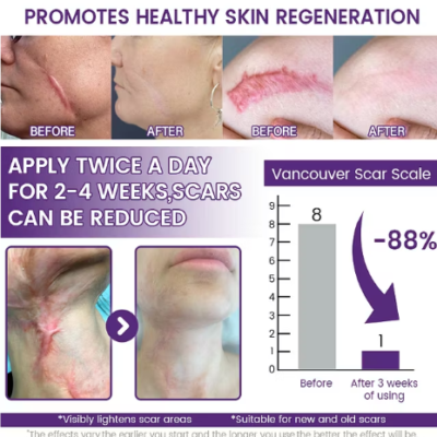 Timilk® ReGenScar Scar Gel